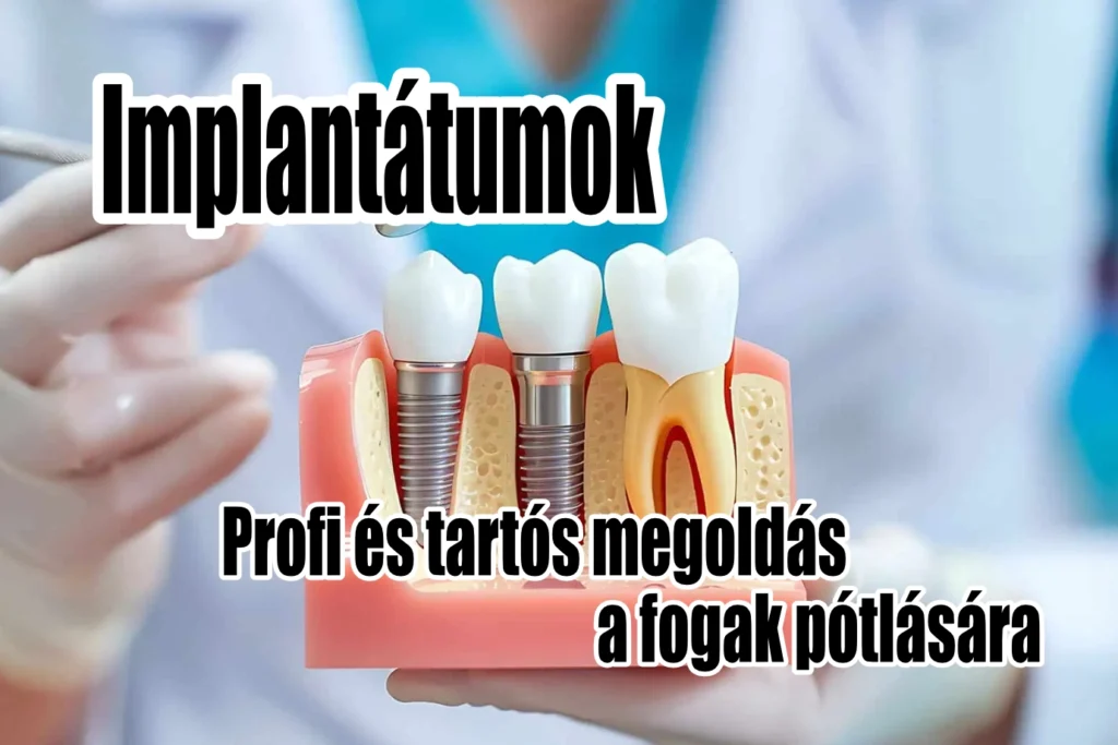 Fogászati implantátum, akár azonnali terhelhetőséggel. DaviDent Érd!