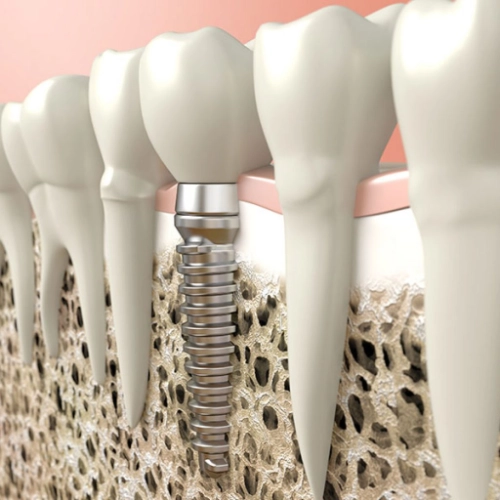 Ha nem lehet megmenteni a letört fogat, akkor foghúzás után akár implantátum segítségével is visszaépíthető a szép mosoly.