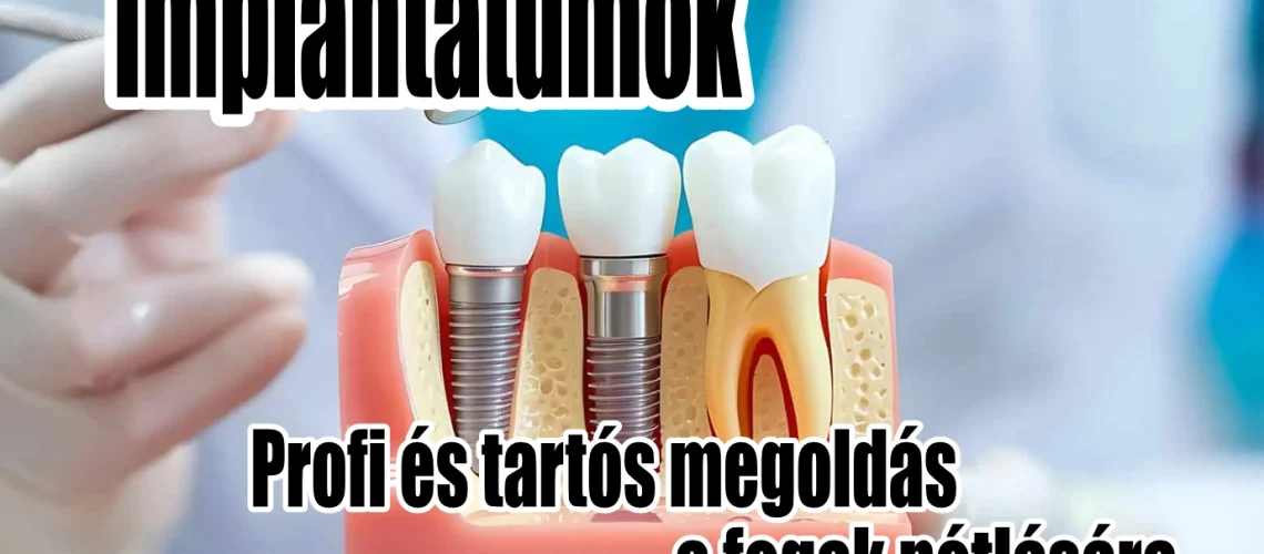 Fogászati implantátum, akár azonnali terhelhetőséggel. DaviDent Érd!